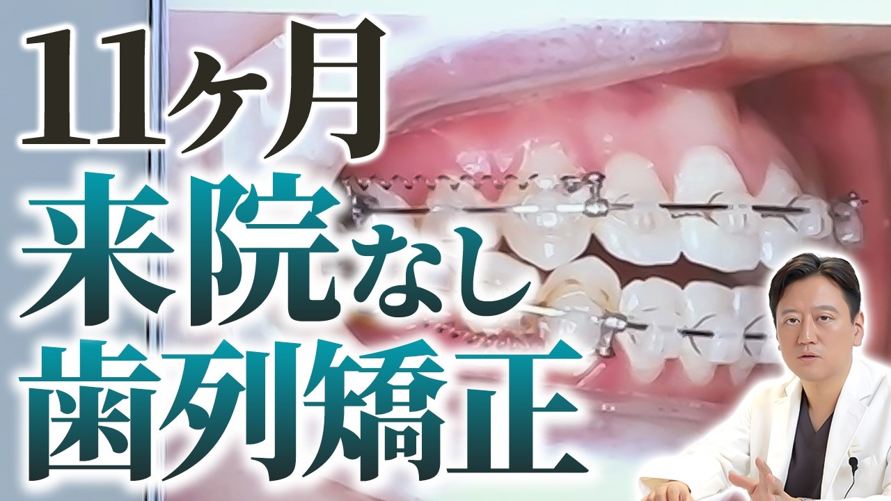 歯列矯正で来院しないとどうなる？抜歯・非抜歯の場合をそれぞれ症例を用いて解説します【審美歯科 歯並び 矯正長引く】