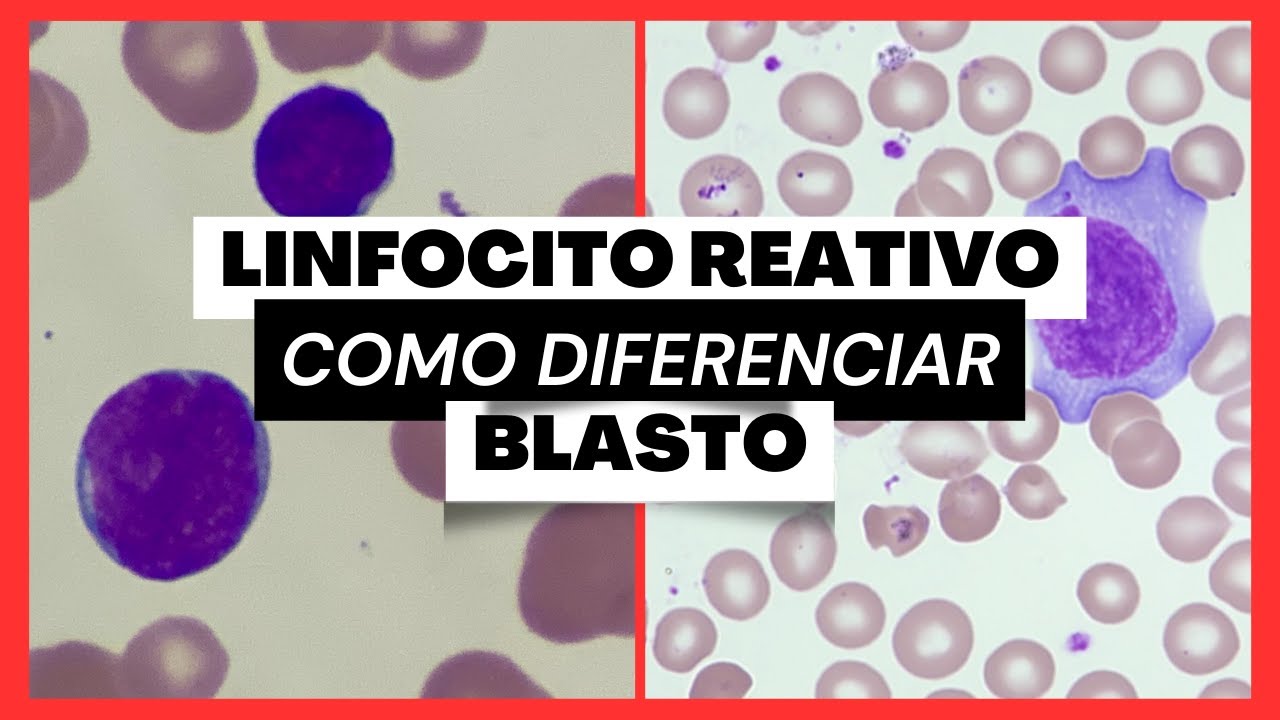 Como Blasto de Linfócito Reativo