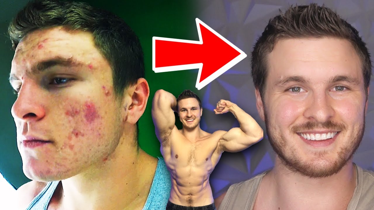 How To AVOID ACNE While Working Out & Gaining Muscle!
