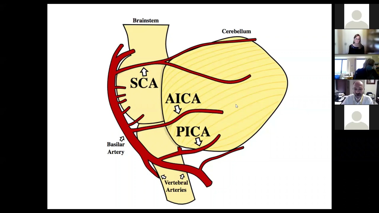 Management of Posterior Circulation Stroke Syndrome (Sept. 28, 2021)