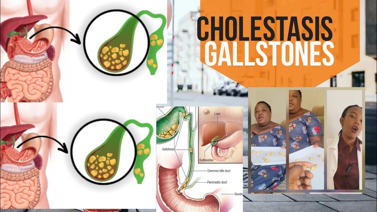 MENYA, CHOLESTASIS/GALLSTONES INDWARA ISHOBORA GUFATA AGASABO K'INDURWE /NIKI,UKO IFATA, UKO IVURWA