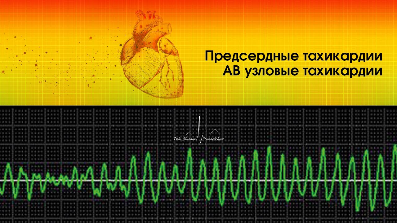 Предсердные тахикардии. АВ узловые тахикардии.