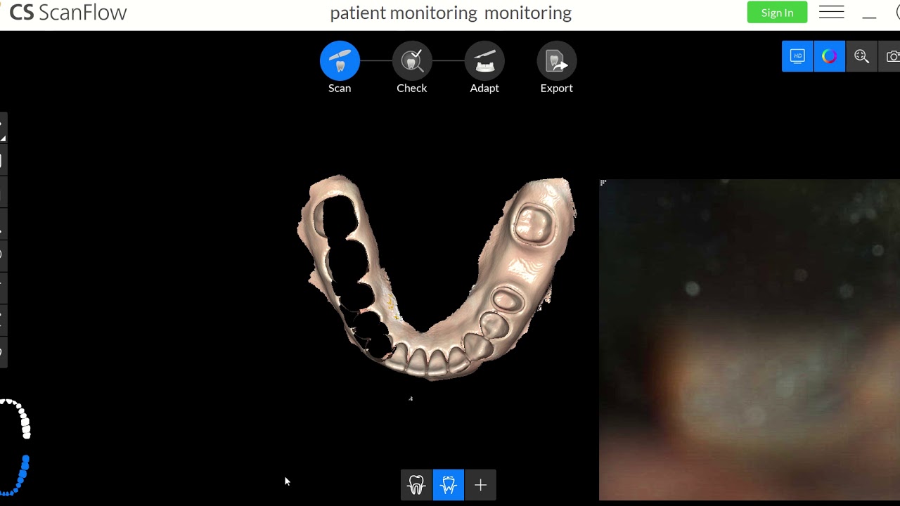 overlaying two scans to monitor patient change in CS ScanFlow
