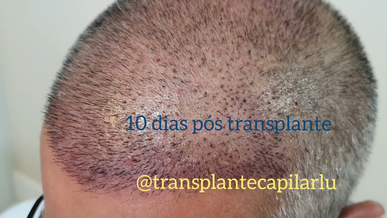 Resultado real transplante capilar FUE após 10 dias grau V #gigasessão cabelo grisalho Dr. Paulo Lu