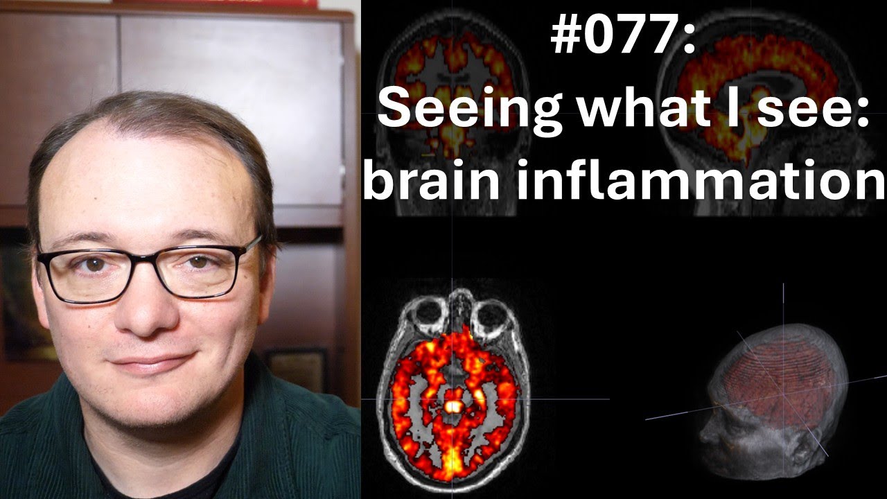 077 - Seeing what I see: brain inflammation