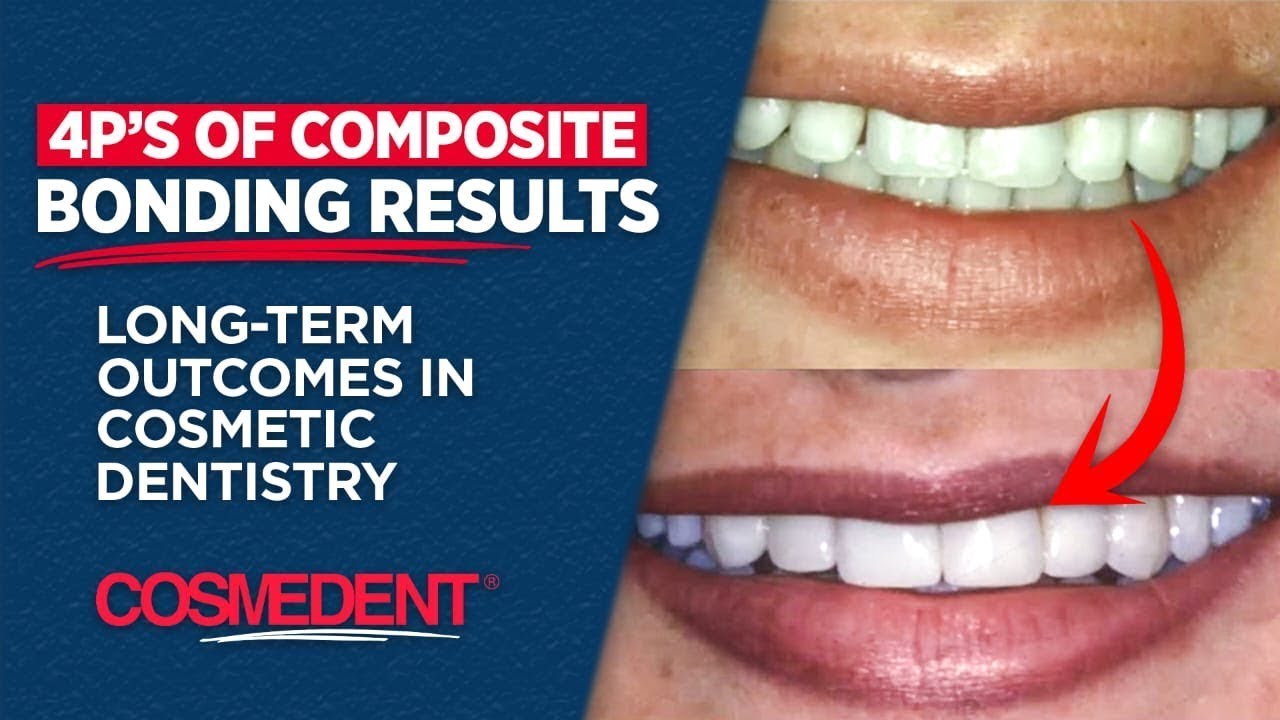 4P’s of Composite Bonding Results  | Long-Term Outcomes in Cosmetic Dentistry