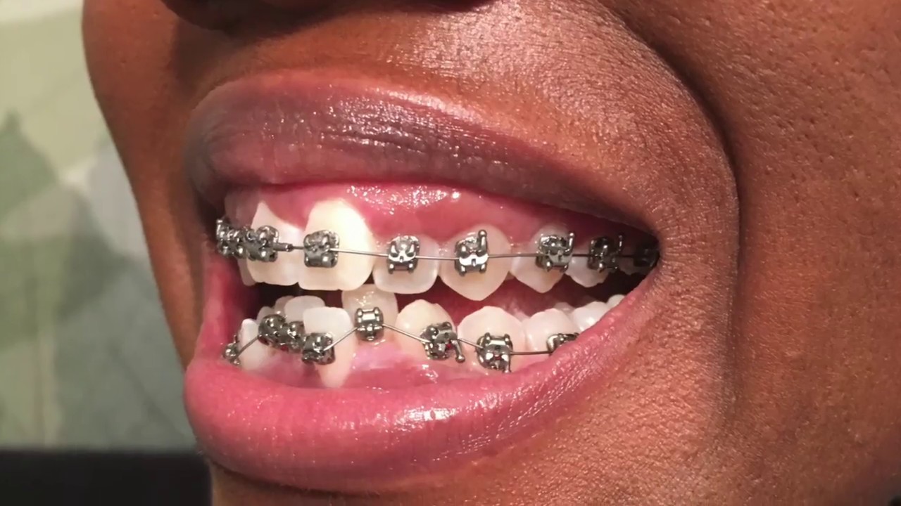 2. I Got Braces Today! PICS + Eating, Bite Block, & Pain