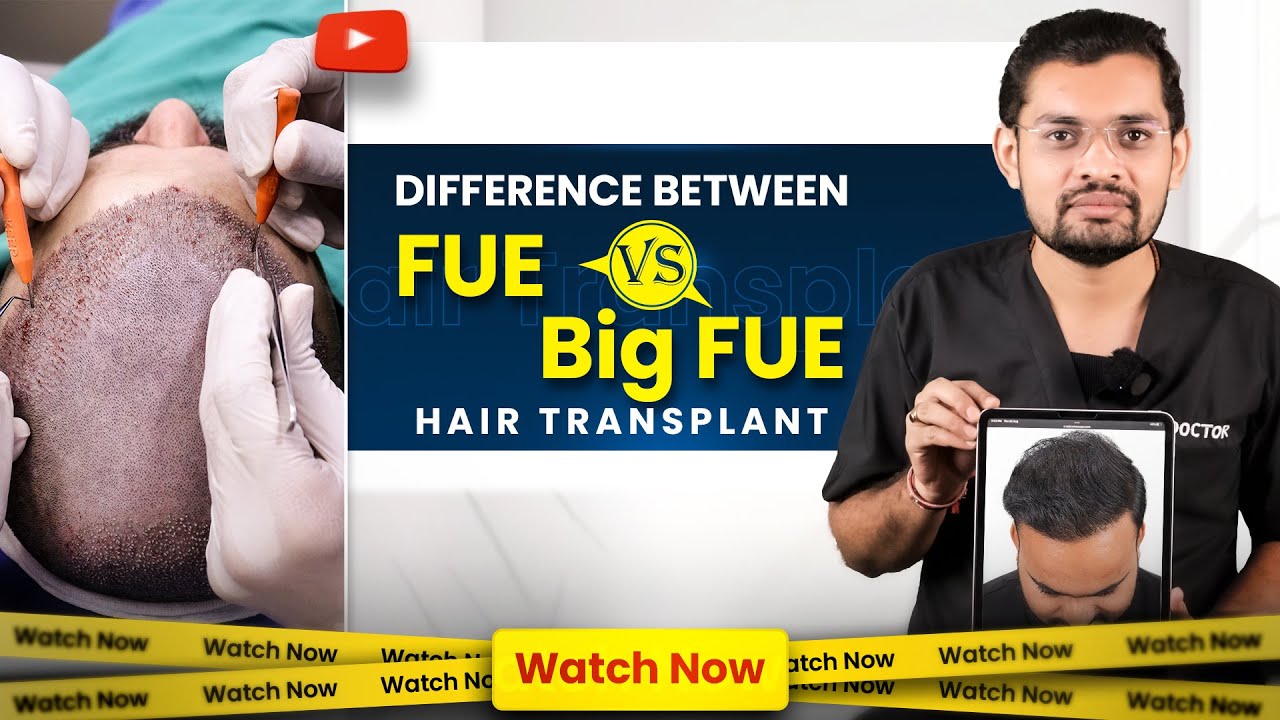 Difference Between Normal FUE vs BIG FUE | BIG FUE Technique Hair Transplant | Dr. Jinkal Kunjadiya
