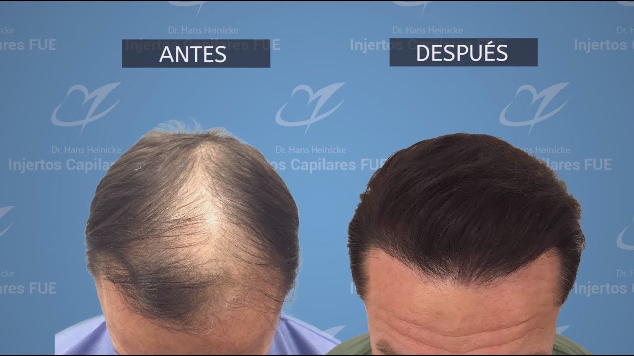 Injerto Capilar Madrid Técnica FUE   3777 Folículos (8908 pelos)   Dr Hans Heinicke