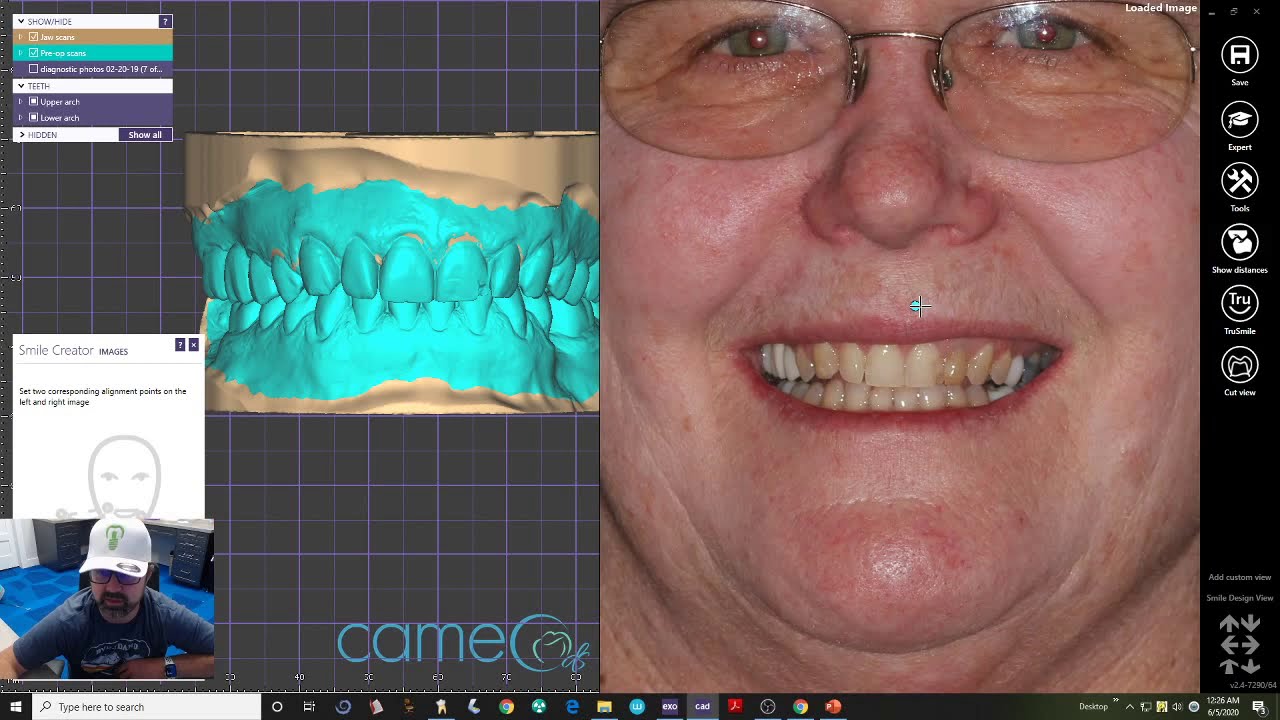 Smile Design 3D - Exocad