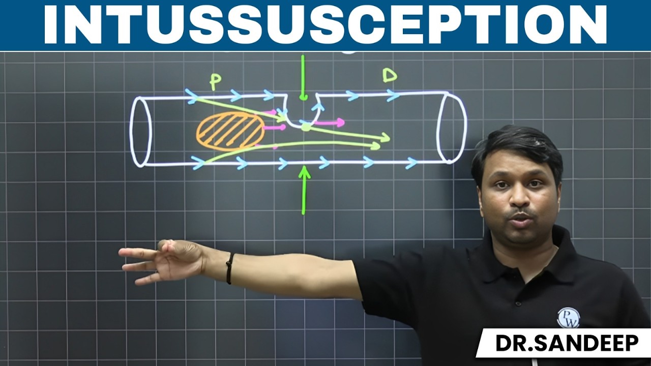 INTUSSUSCEPTION | Surgery | Bailey learned with Dr. Sandeep