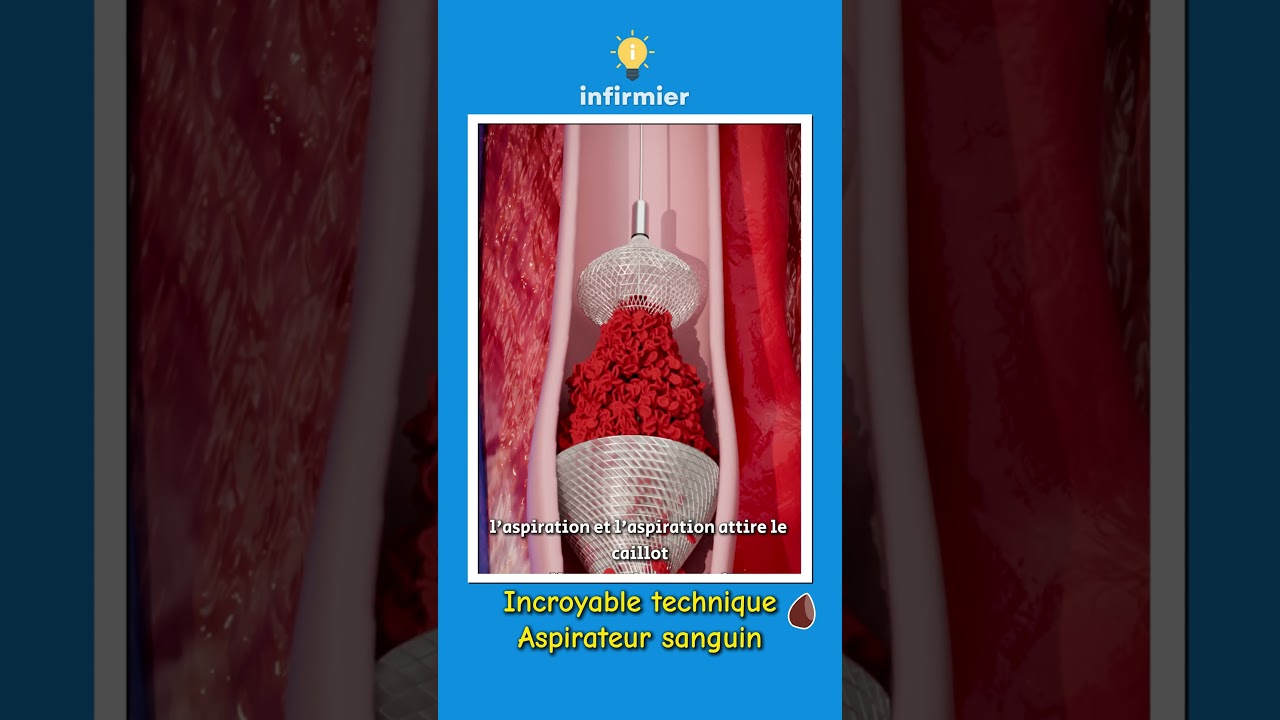 Caillots sanguins mortels : Voici l'aspirateur m&eacute;dical r&eacute;volutionnaire ! #sant&eacute; #shorts