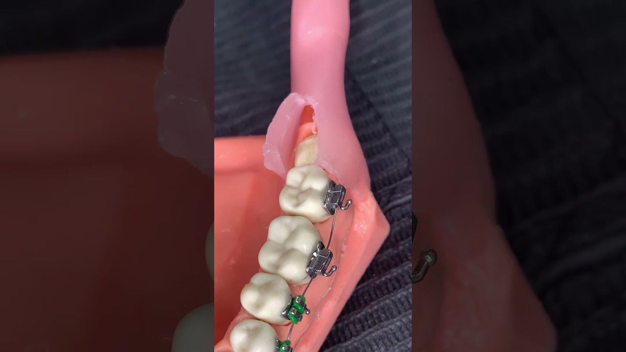 🔥&iquest;Cu&aacute;l fue tu experiencia con las Muelas IMPACTADAS?🔥