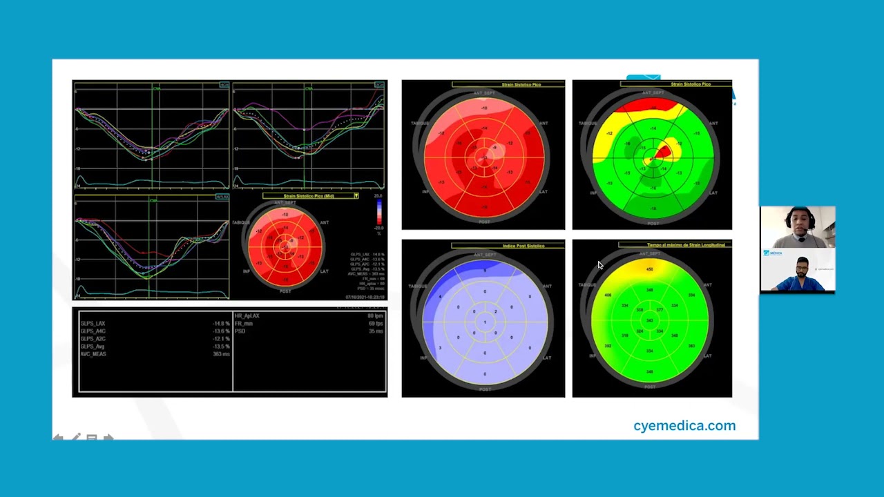 Webinar: Interpretación de curvas de Strain Miocárdico