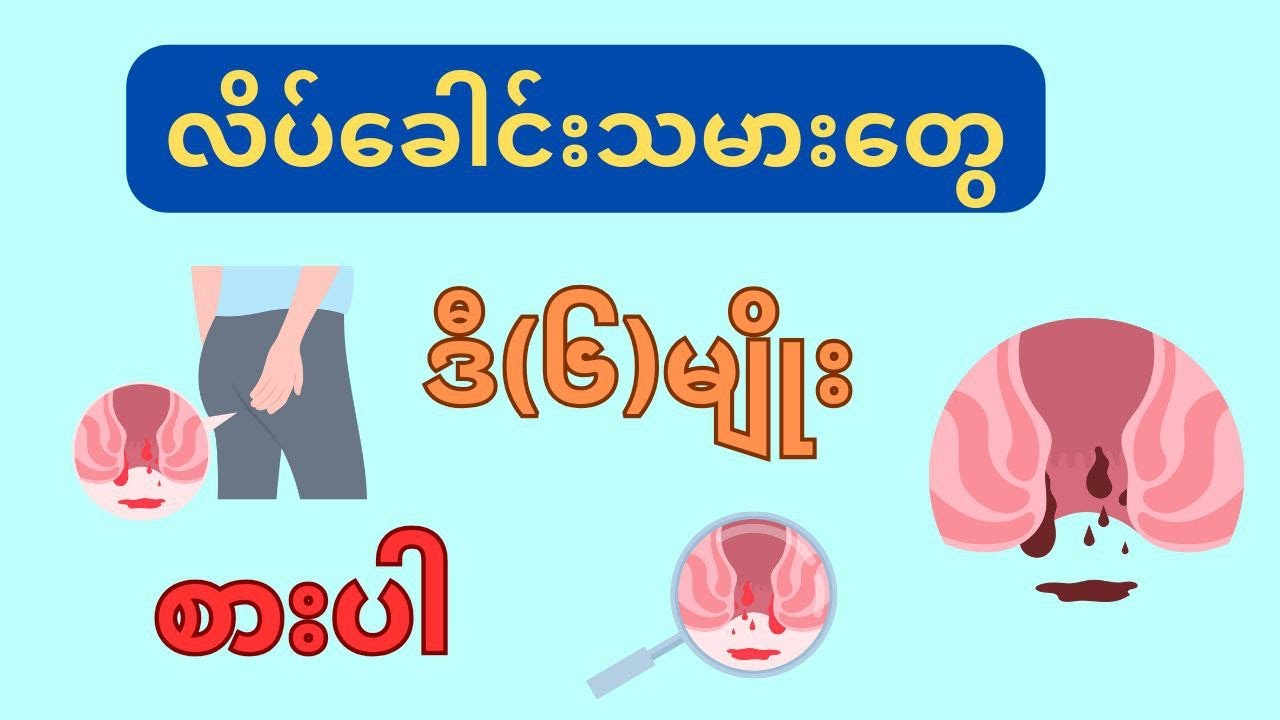လိပ်ခေါင်း သမားတွေ ဒီ၆မျိုးစားပါ