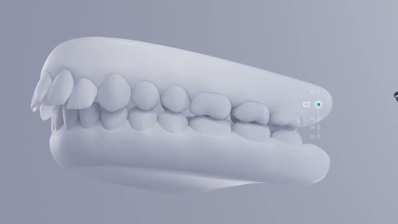 Carriere Motion 3D for Class II Correction with SLX3D Brackets: Doctors Education