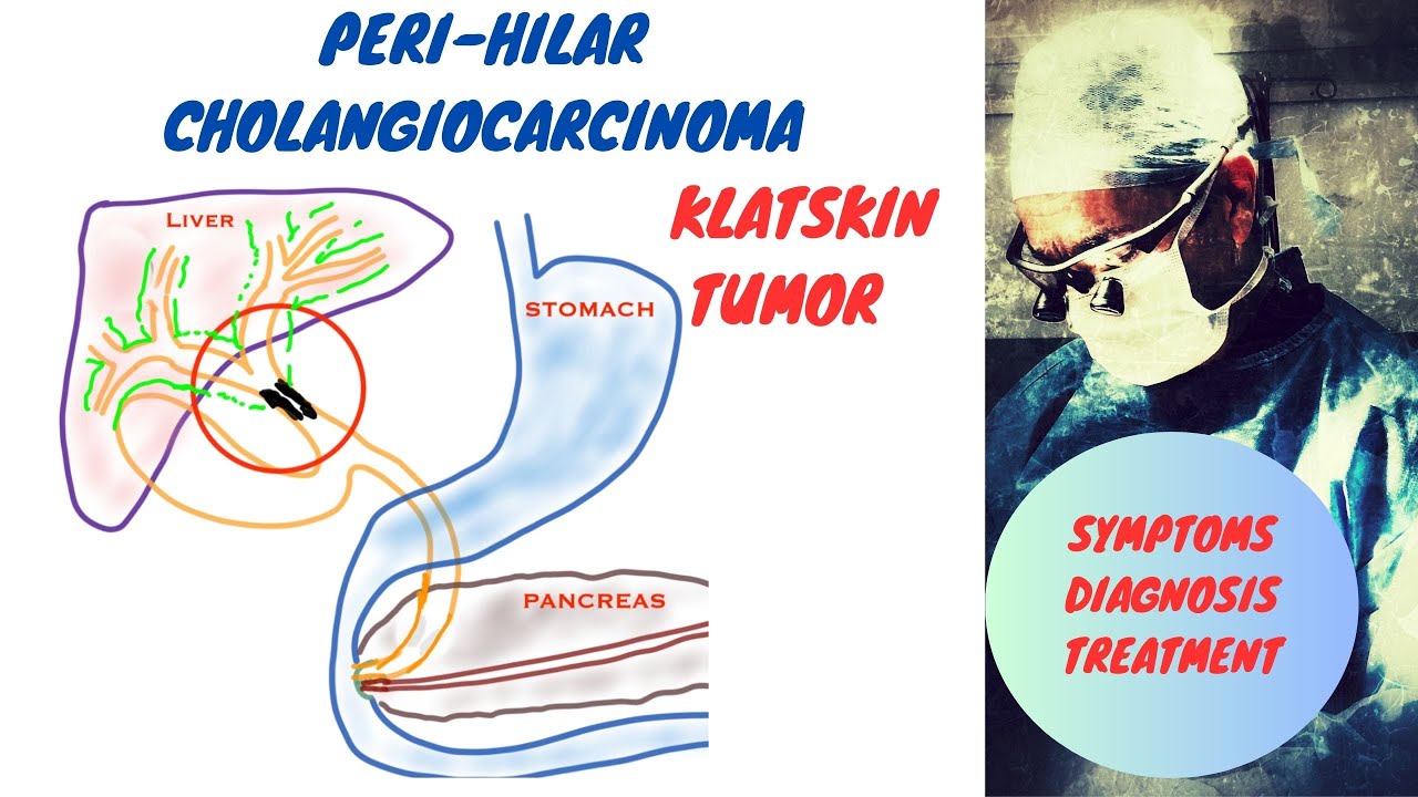 Hilar Cholangiocarcinoma | Klatskin Tumor