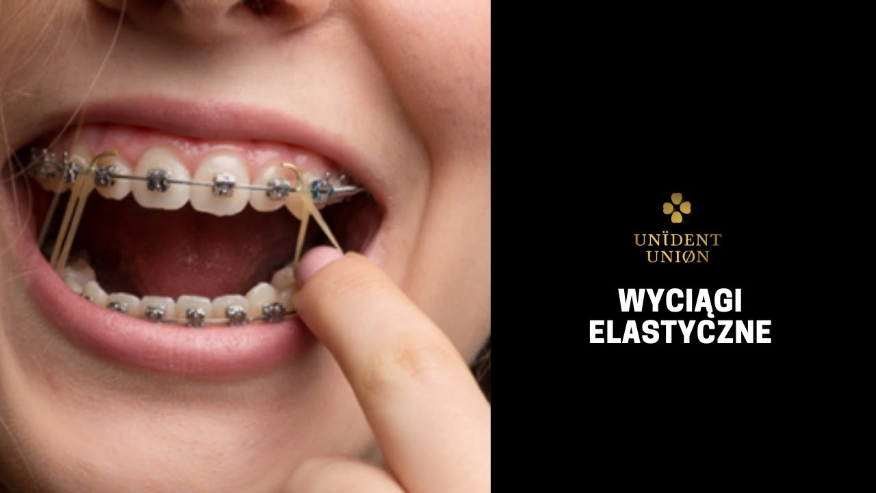 WYCIĄGI ELASTYCZNE - LECZENIE ORTODONTYCZNE
