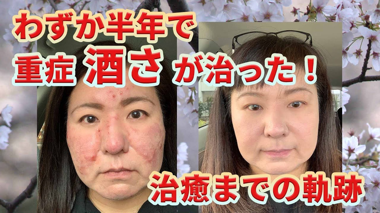 発症から6年、わずか半年で重症「赤ら顔」「酒さ」が治った！