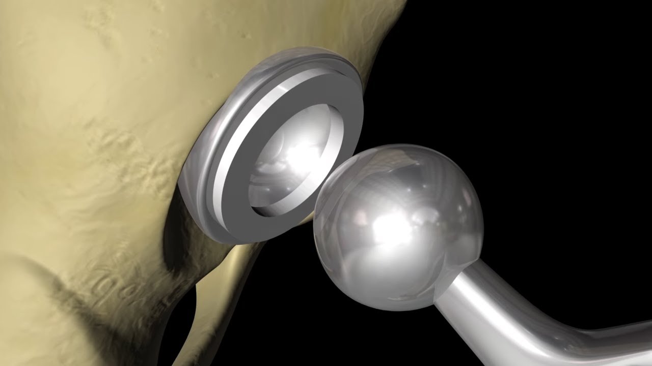 Total Hip Replacement