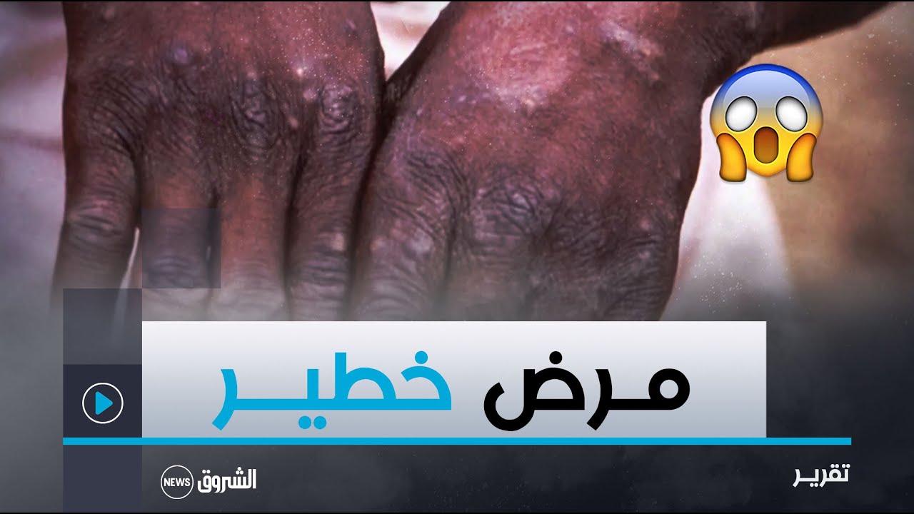حالة طوارئ صحية في افريقيا بسبب تفشي مرض جدري القردة مختصون يطمئنون بخصوص الجزائر