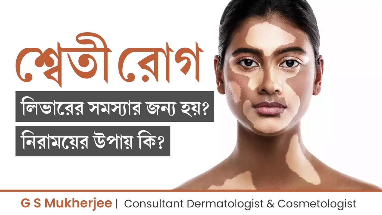 শ্বেতী রোগ কেন হয়? শ্বেতী রোগ নিরাময়ের উপায় | Vitiligo Causes & Treatment