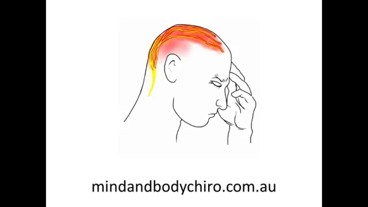 Gold Coast Chiropractor | Cervicogenic Headaches