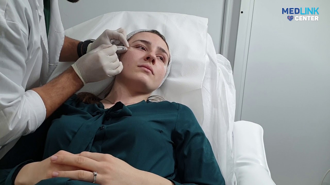 Tratament Toxină Botulinică - Procedură simplă - Pacienta la prima procedură cu tratament botox