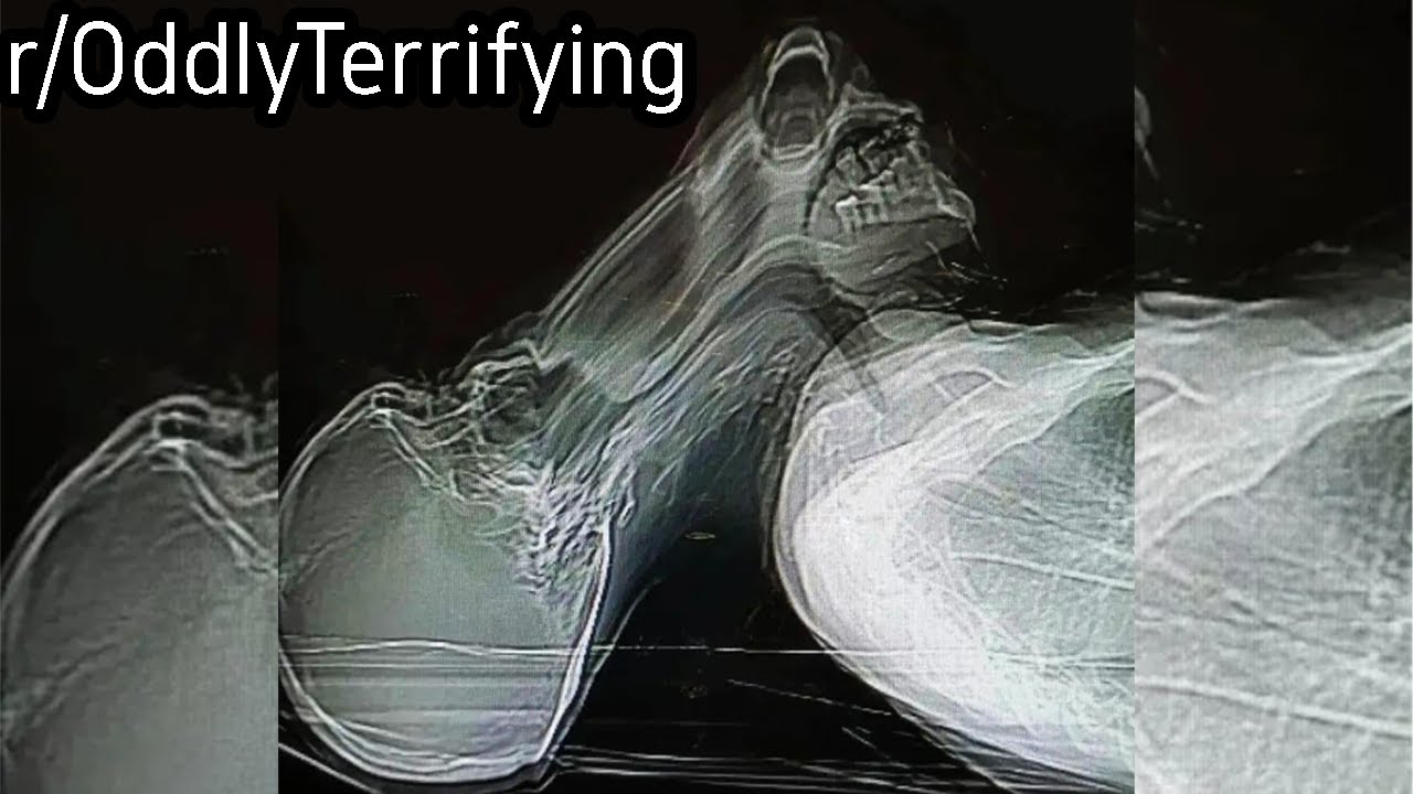 r/OddlyTerrifying | Man Moving during an X-Ray