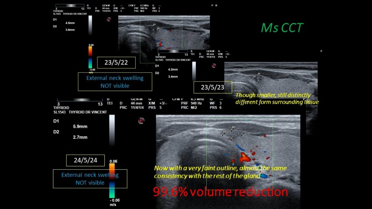 Percutaneous Ethanol Injection (PEI) 3 – Good Outcome