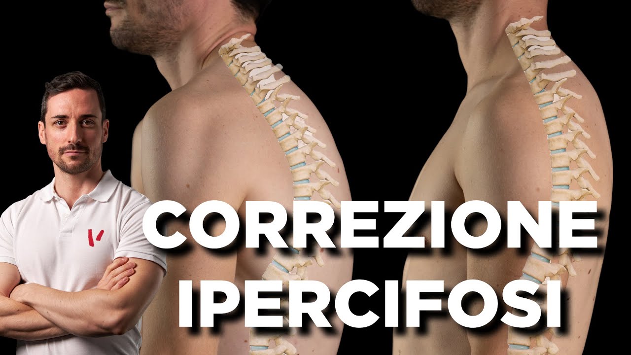 È possibile CORREGGERE L'IPERCIFOSI?