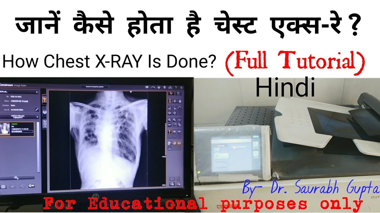 कैसे लिया जाता है छाती का एक्स-रे?(Inside X-RAY Room) | How Chest X-RAY is Done? | Full Explaination