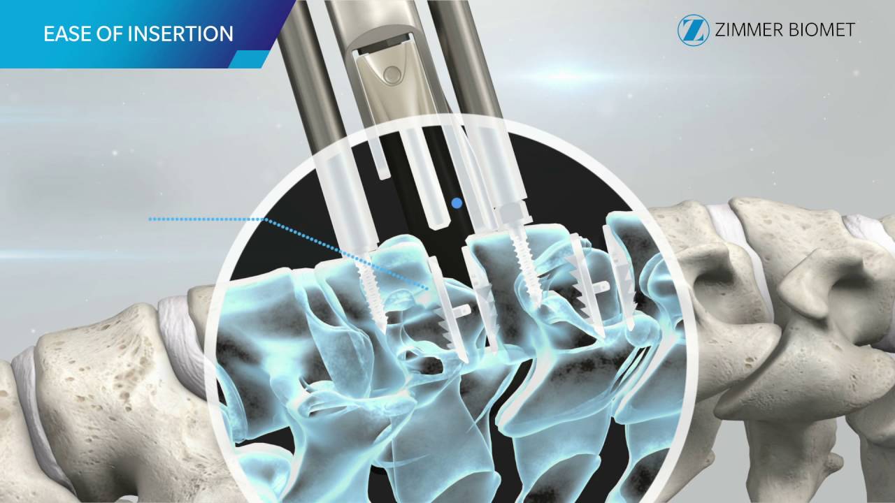 Mobi-C Cervical Disc