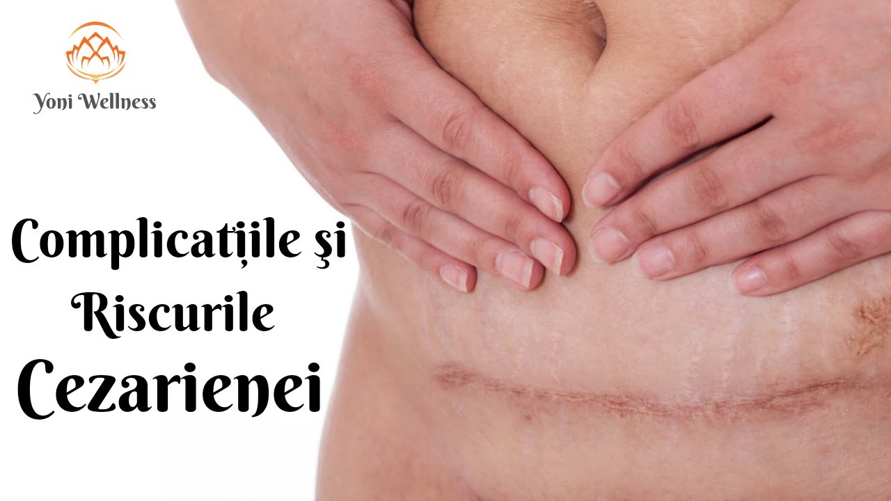 S1.Ep72: Riscuri şi complicații ale naşterii prin operație cezariană| Infecție |Hemoragie| Cicatrice