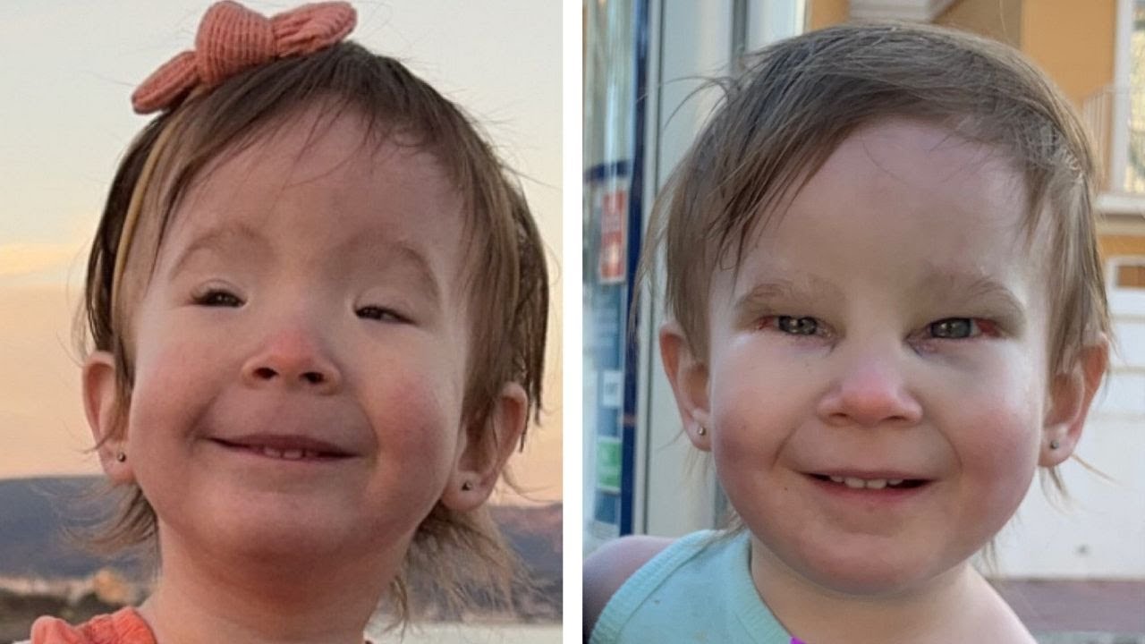 Toddler born visually impaired opens her eyes properly thanks to corrective surgery | SWNS