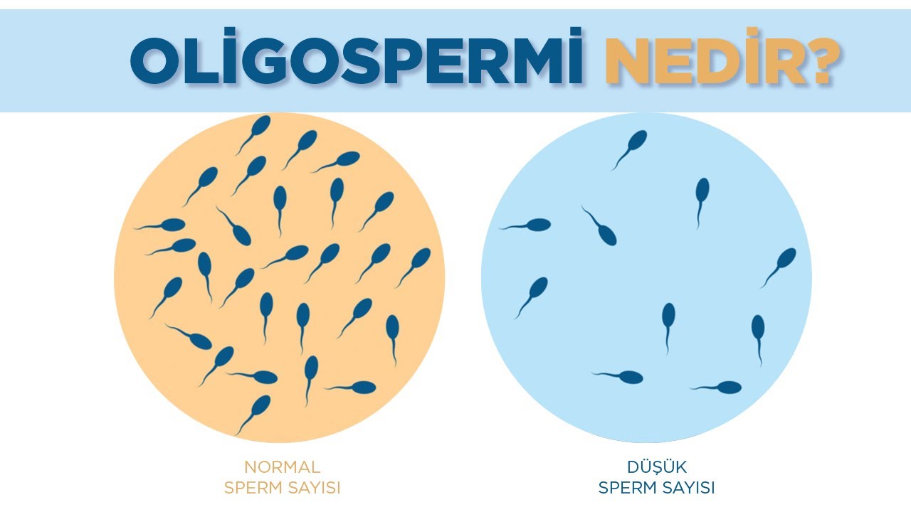 Oligospermi Nedir? Oligospermi Nedenleri ve Tedavisi