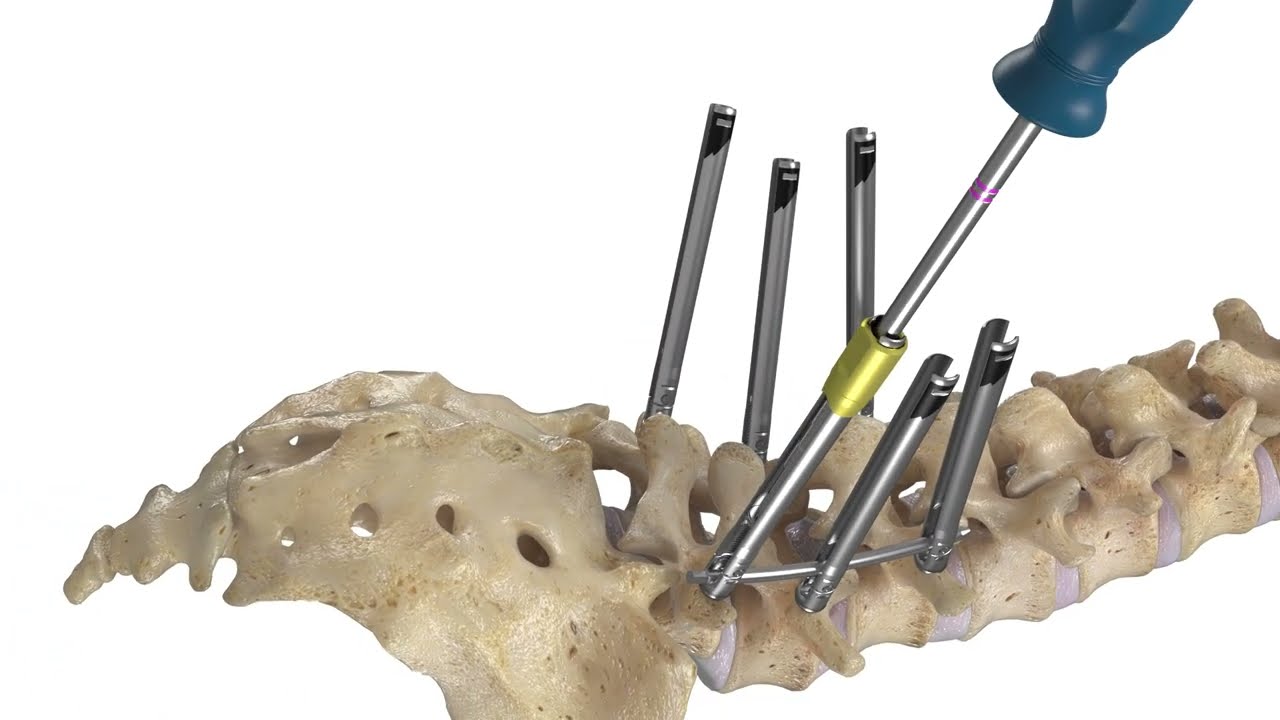Minimally Invasive Spinal Fixation - 3D Spine Implant Animation by Pulse 3D Media