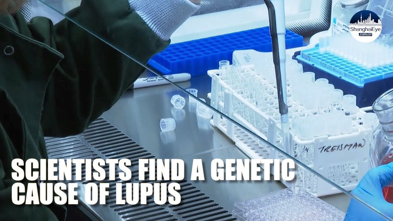 Scientists found gene mutation which causes autoimmune disease lupus