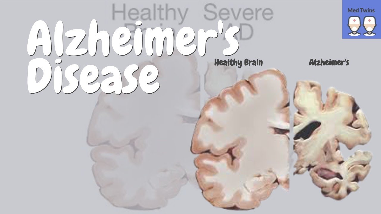 Alzheimer's disease [Pathophysiology, Amyloid plaques and Tau tangles, Risk Factors, Treatment]
