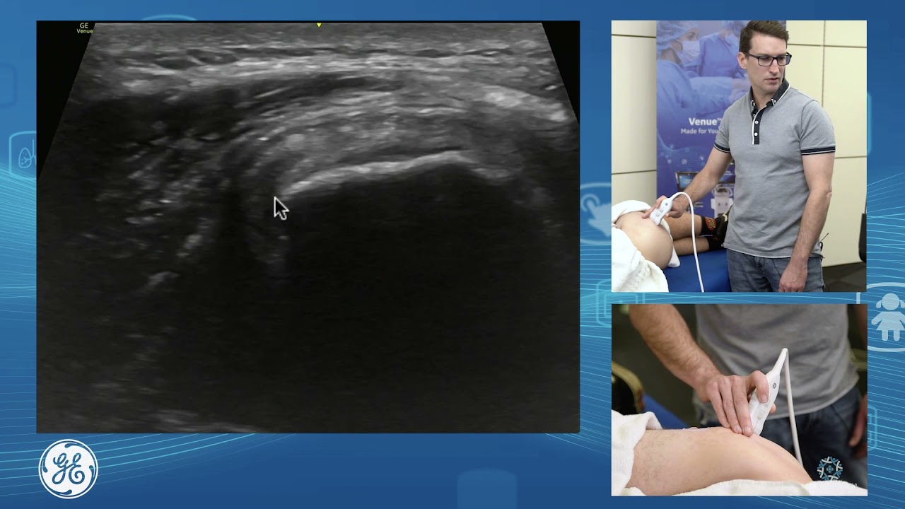 Sonographic assessment of the gluteal tendons for POCUS clinicians