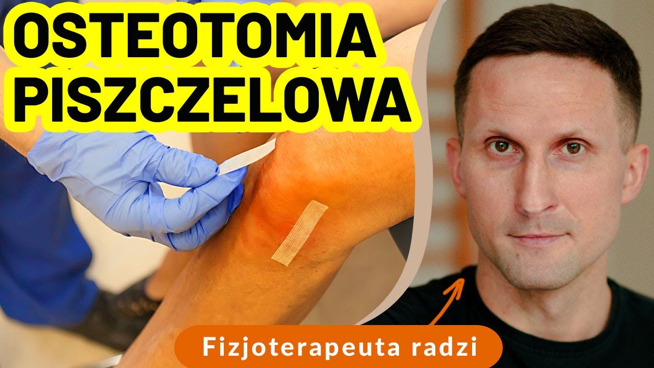 Osteotomia piszczelowa – kiedy warto ją rozważyć i co trzeba wiedzieć przed operacją?