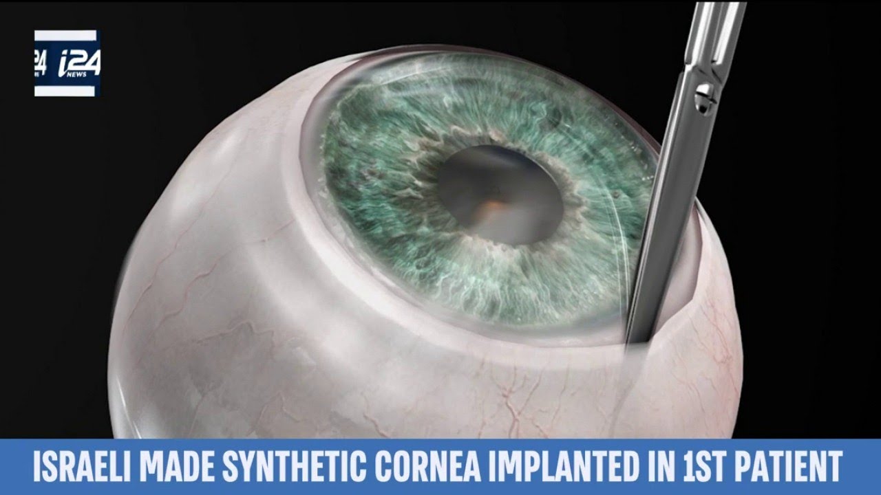 Israeli-Made Synthetic Cornea Implanted in 1st Patient