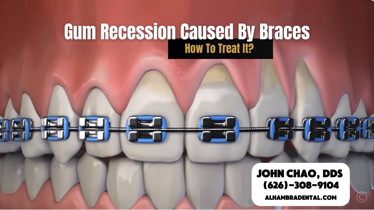 Gum Recession Is a Common Side Effect of Braces?  How To Treat It? 🦷✨#gumrecession #braces
