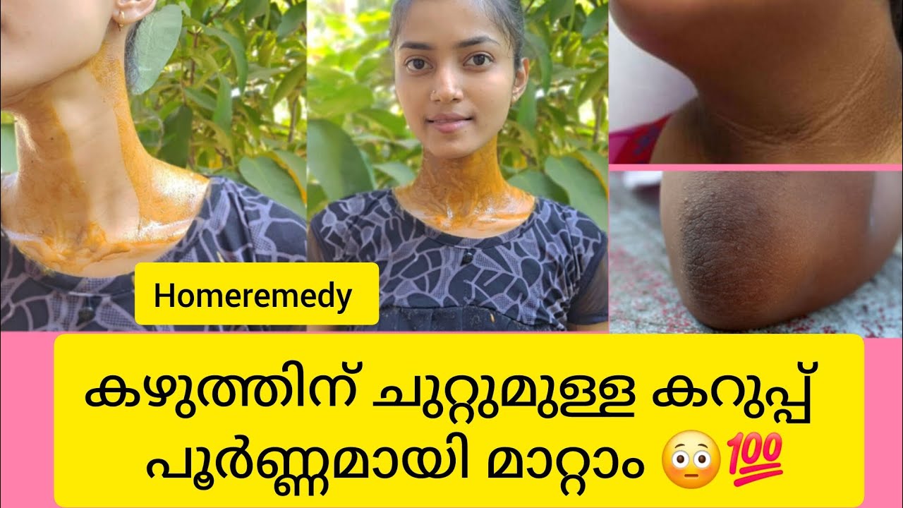 കഴുത്ത്,കക്ഷം,കൈമുട്ട്,കാൽമുട്ട് കറുപ്പ് പൂർണമായി മാറ്റാം 😳💯homeremedy😲live result #darknessremoval