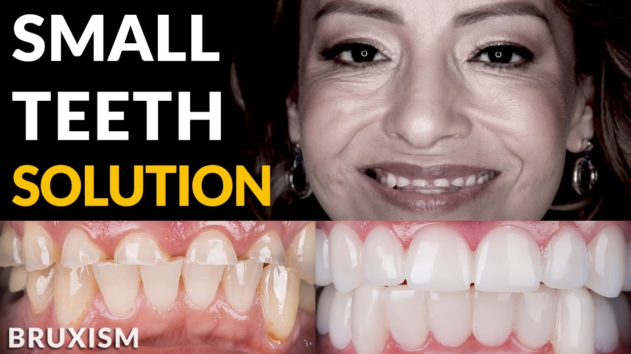 Small Teeth from Grinding/Bruxism? Try Snap On Veneers [INSTANT Makeover]