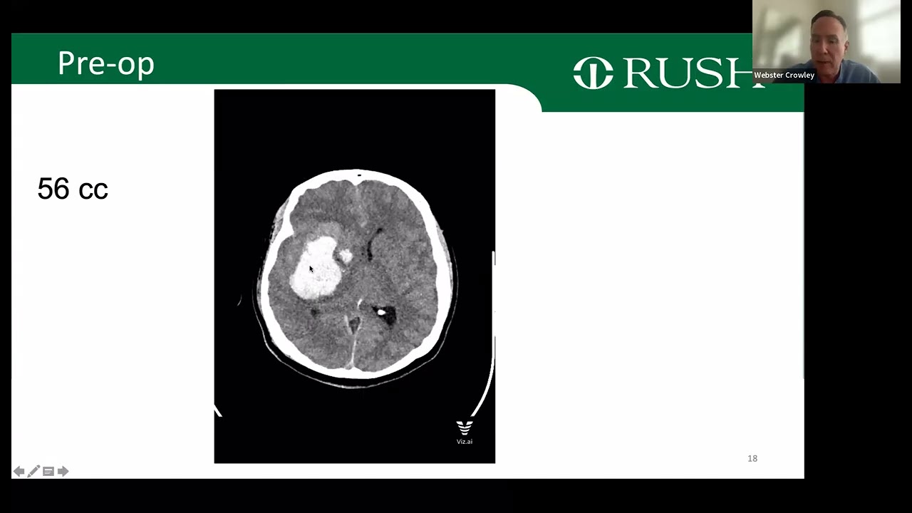 Dr. Webster Crowley- Minimmaly Invasive ICH Evacuation: Go Big or Go Home? (05/15/2025)