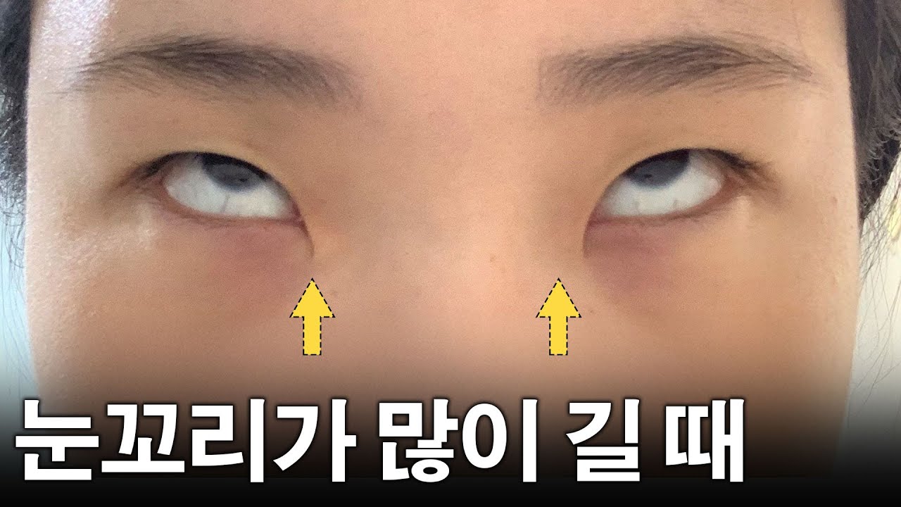 새부리눈? 눈의 앞꼬리와 이소성 눈물길 - 이런 눈은 어떻게 해야 할까?