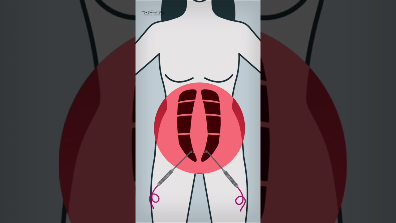 Di&aacute;stase Abdominal: Como funciona a corre&ccedil;&atilde;o de di&aacute;stase por cirurgia rob&oacute;tica