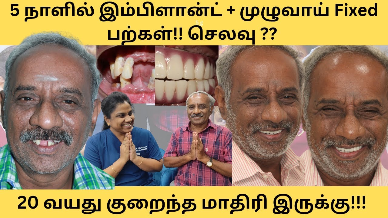 56 வயதில் இம்பிளான்ட் +முழுவாய் fixed பல் சிகிச்சை! மொத்த சிகிச்சை அனுபவம் , செலவு#dentalimplants