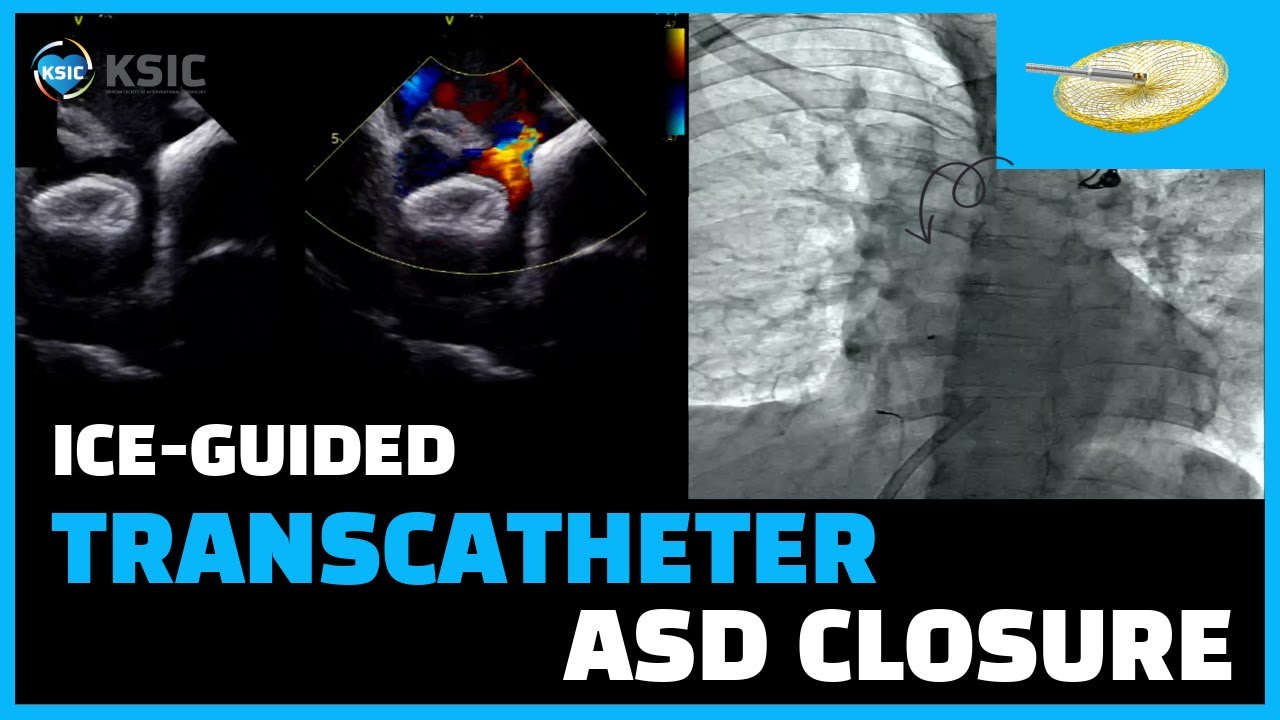 [SUB]Transcatheter ASD closure (ICE-guided)